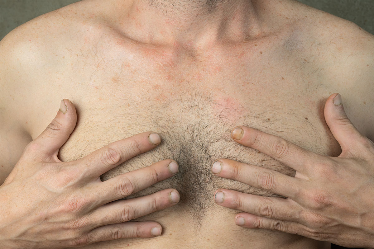 Proper scar management techniques, such as silicone gel sheets, massage therapy, and the use of scar-reducing creams or ointments, can significantly improve the appearance of gynecomastia scars over time.