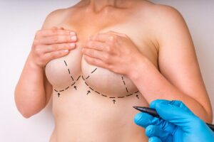 Female patient with breast creases marked by a doctor in relation to mastopexy.