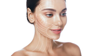 Woman with facial lines and markings illustrating the SMAS facelift procedure for natural results.