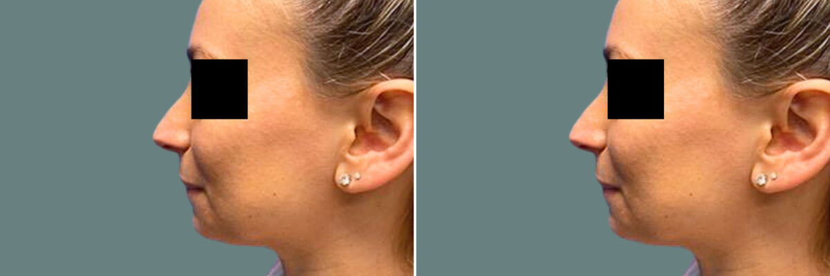 Rhinoplasty before and after photos in Miami Beach, FL, Patient 7209