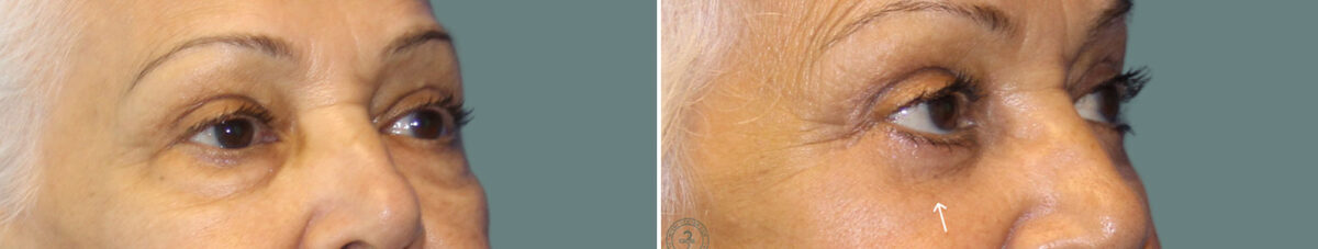 Blepharoplasty before and after photos in Miami Beach, FL, Patient 7270