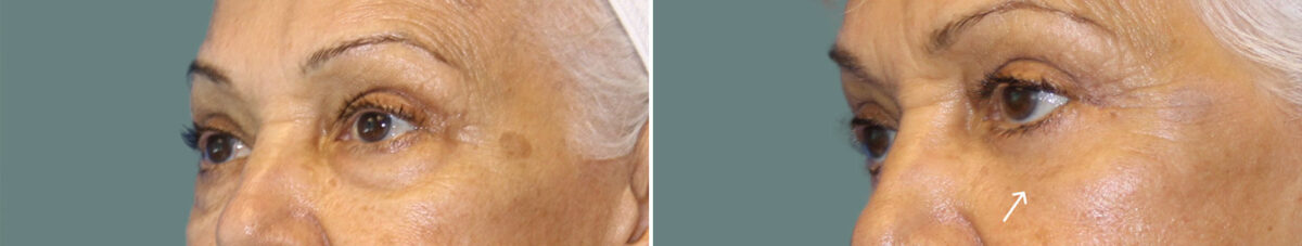 Blepharoplasty before and after photos in Miami Beach, FL, Patient 7270