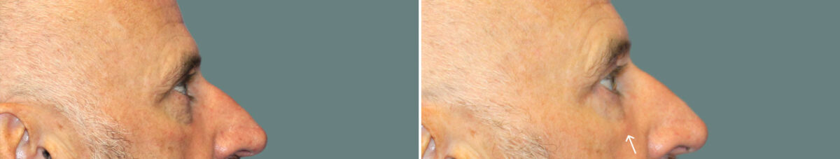 Blepharoplasty before and after photos in Miami Beach, FL, Patient 7275