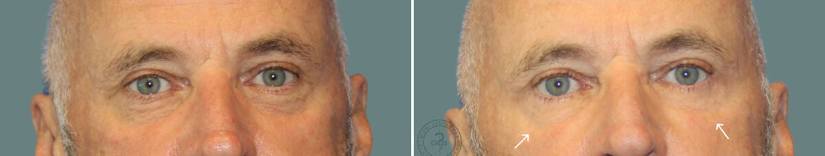 Blepharoplasty before and after photos in Miami Beach, FL, Patient 7275