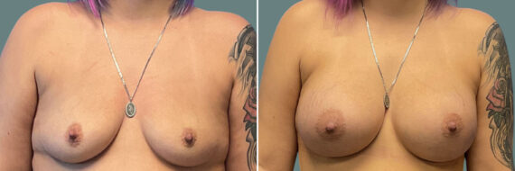Breast Augmentation before and after photos in Miami Beach, FL, Patient 7338