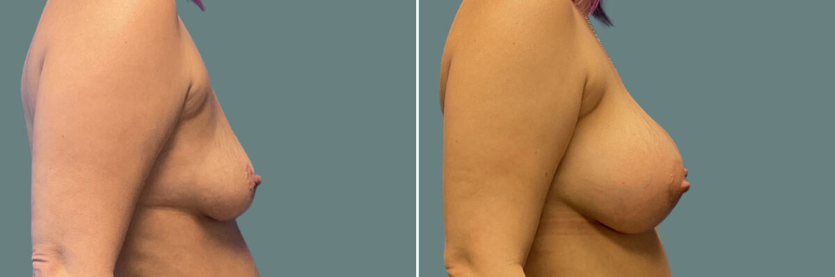 Breast Augmentation before and after photos in Miami Beach, FL, Patient 7338