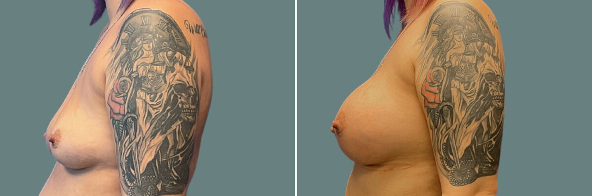 Breast Augmentation before and after photos in Miami Beach, FL, Patient 7338