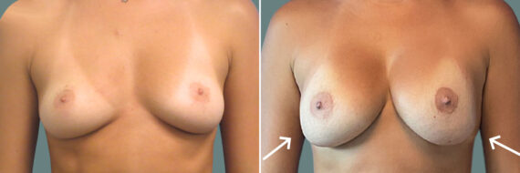 Breast Augmentation before and after photos in Miami Beach, FL, Patient 7348