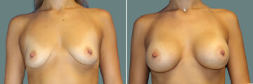 Breast Augmentation before and after photos in Miami Beach, FL, Patient 7355