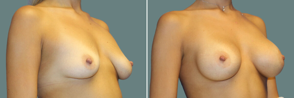 Breast Augmentation before and after photos in Miami Beach, FL, Patient 7355