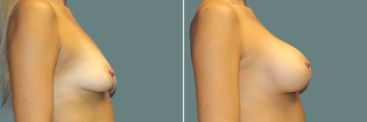 Breast Augmentation before and after photos in Miami Beach, FL, Patient 7355