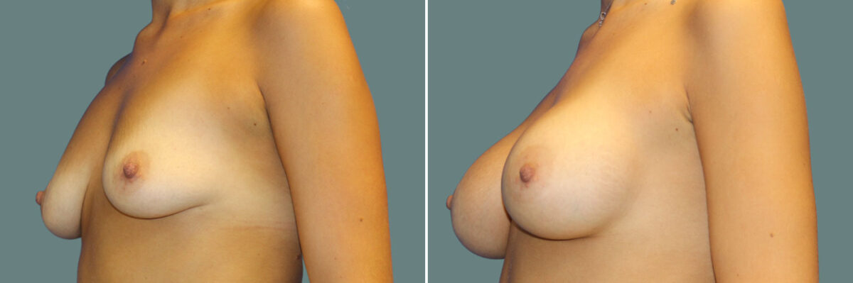 Breast Augmentation before and after photos in Miami Beach, FL, Patient 7355