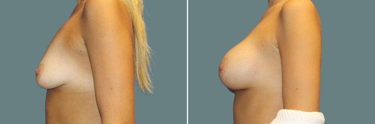 Breast Augmentation before and after photos in Miami Beach, FL, Patient 7355