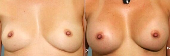 Breast Augmentation before and after photos in Miami Beach, FL, Patient 7371