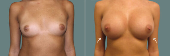 Breast Augmentation before and after photos in Miami Beach, FL, Patient 7381