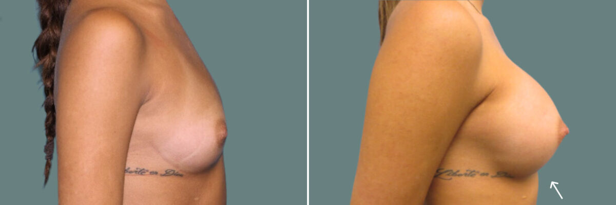 Breast Augmentation before and after photos in Miami Beach, FL, Patient 7381