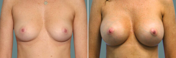 Breast Augmentation before and after photos in Miami Beach, FL, Patient 7388