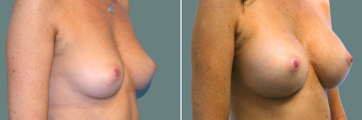 Breast Augmentation before and after photos in Miami Beach, FL, Patient 7388