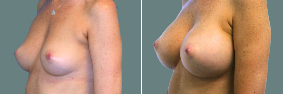 Breast Augmentation before and after photos in Miami Beach, FL, Patient 7388