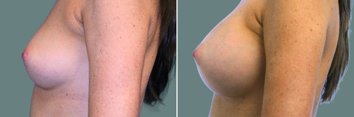 Breast Augmentation before and after photos in Miami Beach, FL, Patient 7388