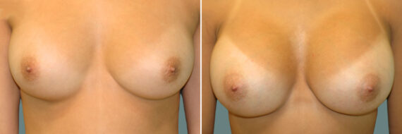 Breast Augmentation before and after photos in Miami Beach, FL, Patient 7401
