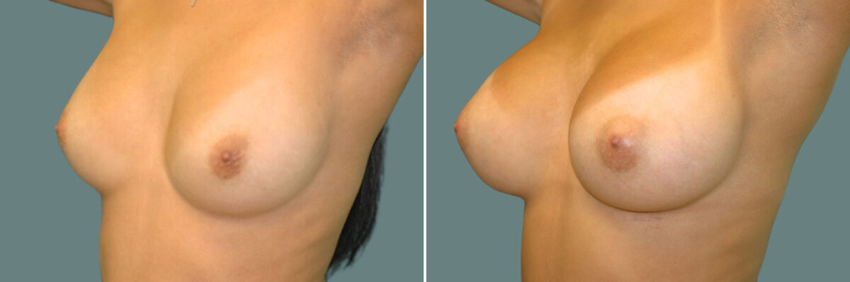 Breast Augmentation before and after photos in Miami Beach, FL, Patient 7401