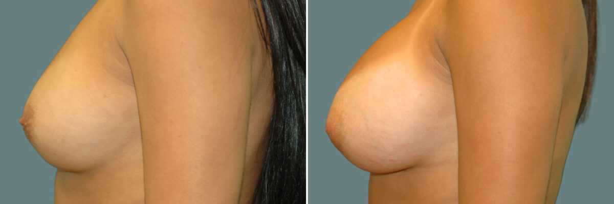 Breast Augmentation before and after photos in Miami Beach, FL, Patient 7401