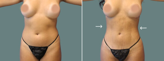 Liposuction before and after photos in Miami Beach, FL, Patient 7414