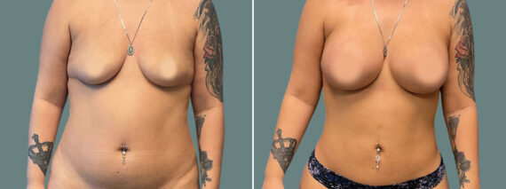 Liposuction before and after photos in Miami Beach, FL, Patient 7418