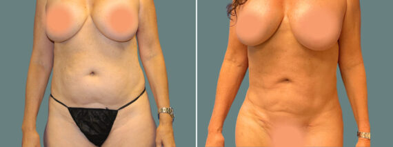 Liposuction before and after photos in Miami Beach, FL, Patient 7440
