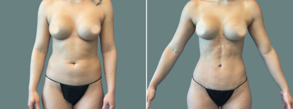 Liposuction before and after photos in Miami Beach, FL, Patient 7450