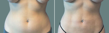 Liposuction before and after photos in Miami Beach, FL, Patient 7486