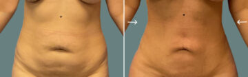 Liposuction before and after photos in Miami Beach, FL, Patient 7499