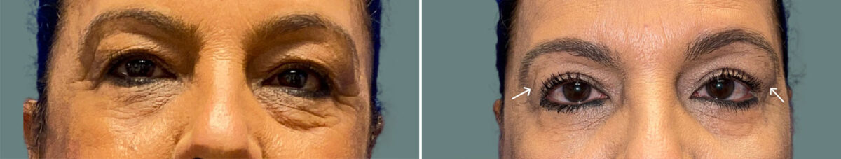 Blepharoplasty before and after photos in Miami Beach, FL, Patient 7542