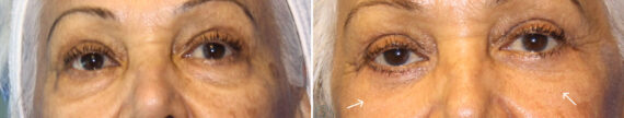 Blepharoplasty before and after photos in Miami Beach, FL, Patient 7573