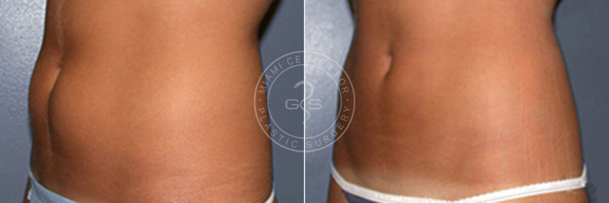 Liposuction before and after photos in Miami Beach, FL, Patient 3288