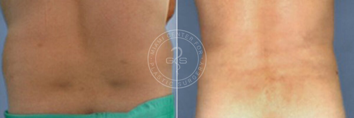 Liposuction before and after photos in Miami Beach, FL, Patient 3301