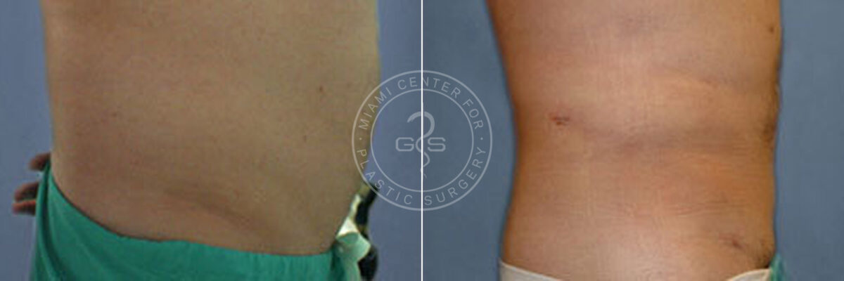 Liposuction before and after photos in Miami Beach, FL, Patient 3301