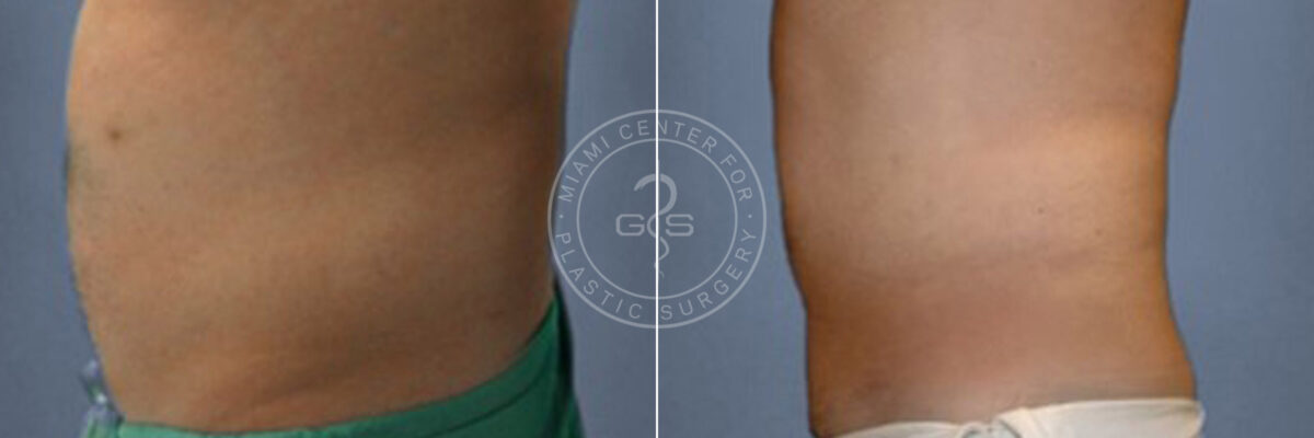 Liposuction before and after photos in Miami Beach, FL, Patient 3301