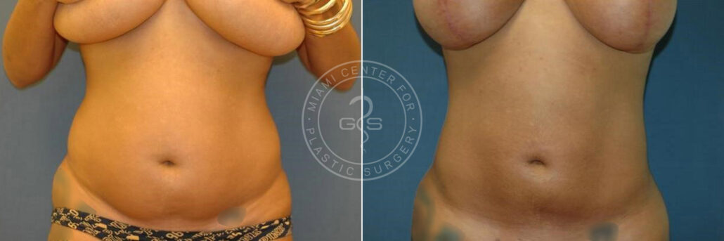 patient-3311-liposuction-before-after