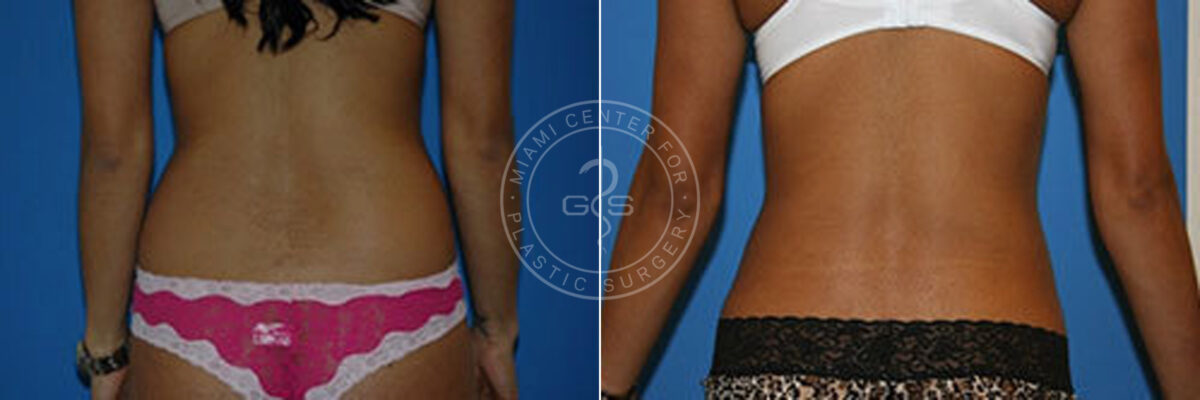 Liposuction before and after photos in Miami Beach, FL, Patient 3315