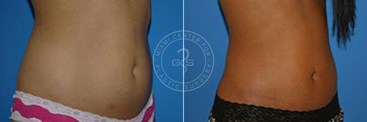 Liposuction before and after photos in Miami Beach, FL, Patient 3315