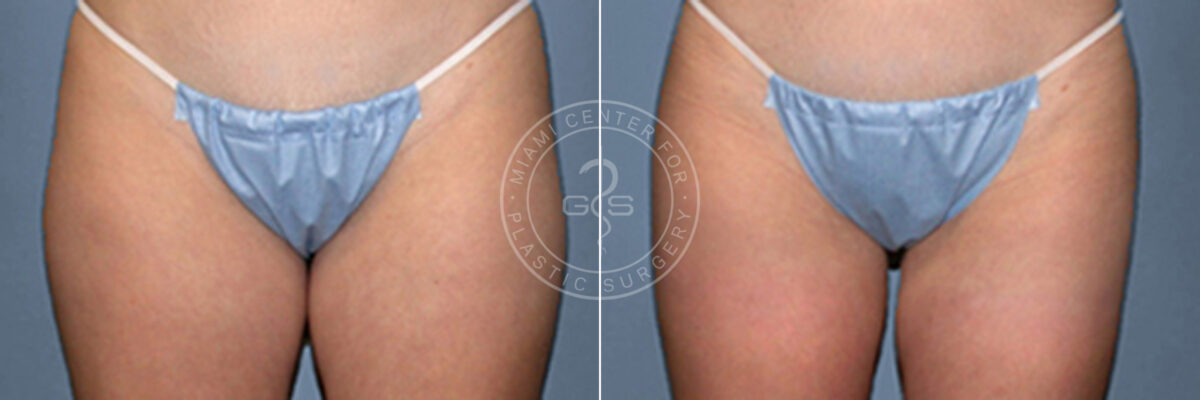 Liposuction before and after photos in Miami Beach, FL, Patient 3330