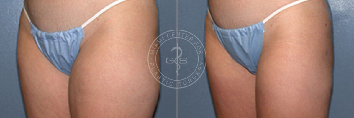 Liposuction before and after photos in Miami Beach, FL, Patient 3330