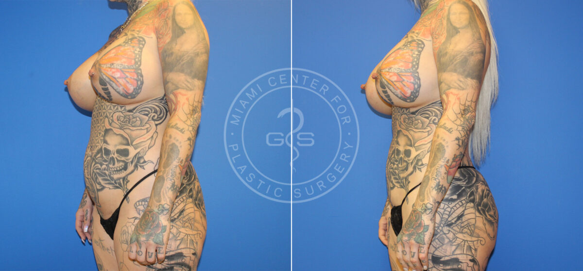 Fat Transfer before and after photos in Miami Beach, FL, Patient 5508