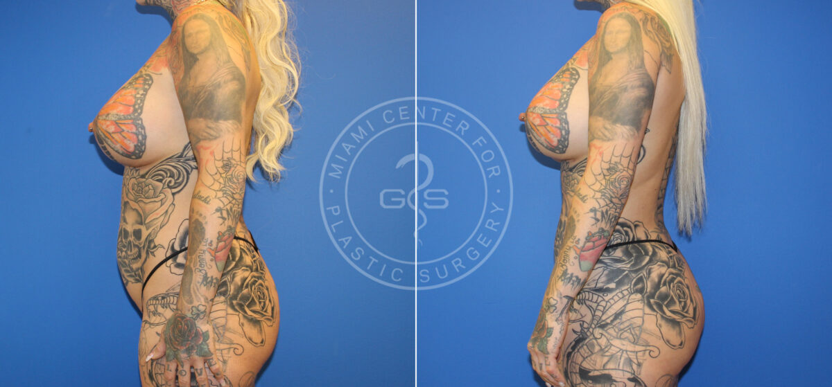 Fat Transfer before and after photos in Miami Beach, FL, Patient 5508