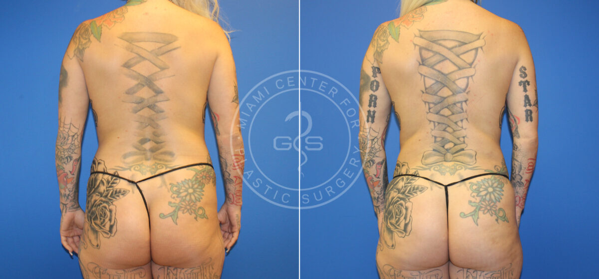 Fat Transfer before and after photos in Miami Beach, FL, Patient 5508