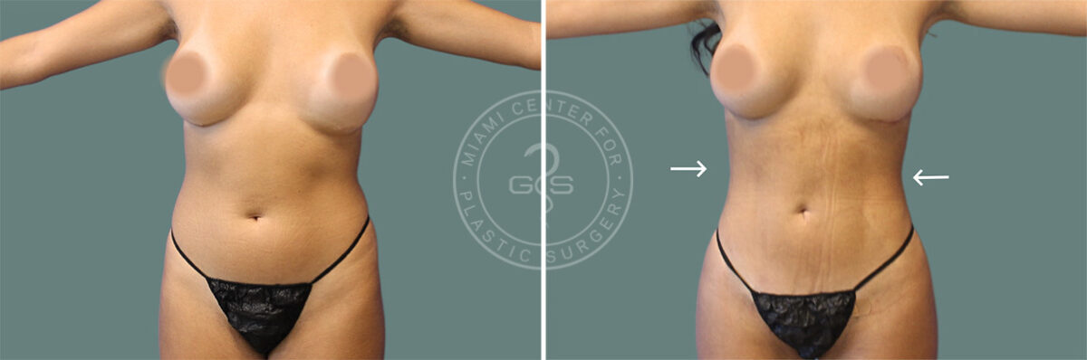 Liposuction before and after photos in Miami Beach, FL, Patient 7414