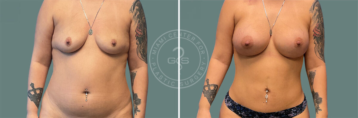 Liposuction before and after photos in Miami Beach, FL, Patient 7418