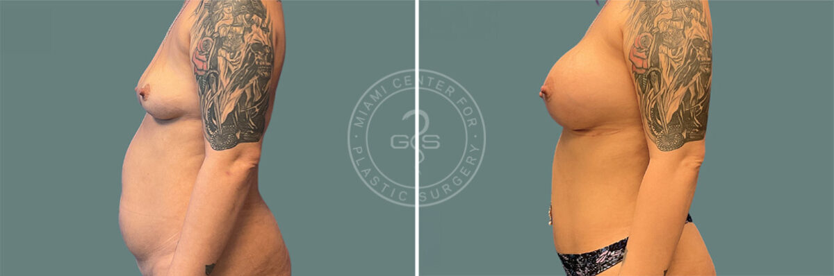 Liposuction before and after photos in Miami Beach, FL, Patient 7418